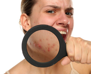 Studio shot of young woman with acne holding magnifying glass to her face, isolated on white...
