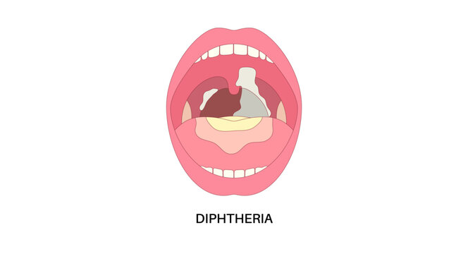 diphtheria oral disease