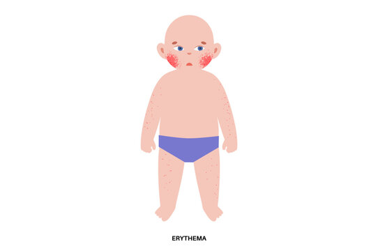 Fifth disease or erythema infectiosum
