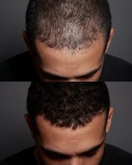 Fototapeta premium The bald area in the center of the head compared to the thick hair that covers it.