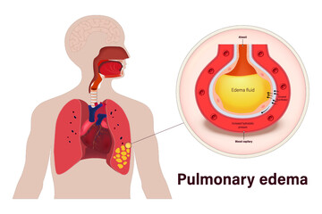Pulmonary edema. Lung diseases anatomy. Human respiratory system.