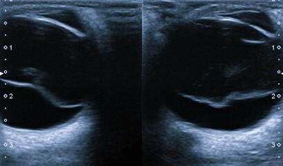 Posterior vitreous detachment.USG Posterior vitreous detachment (or hyaloid detachment) occurs when...