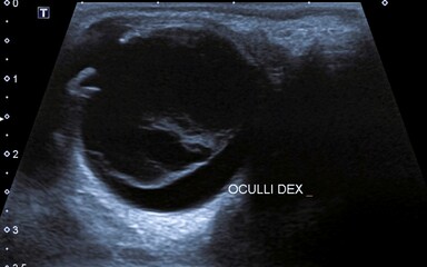 Posterior vitreous detachment.USG Posterior vitreous detachment (or hyaloid detachment) occurs when...