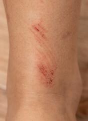 A person's leg has a red mark on it