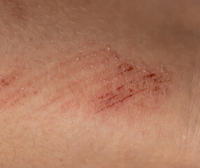 A person's arm has a red mark on it