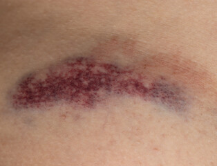 A bruise on a person's arm