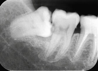 Periapical x-ray showing malposition of right lower wisdom tooth and caries on a second mandibular...