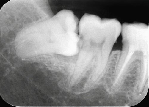 Periapical x-ray showing malposition of right lower wisdom tooth and caries on a second mandibular molar.