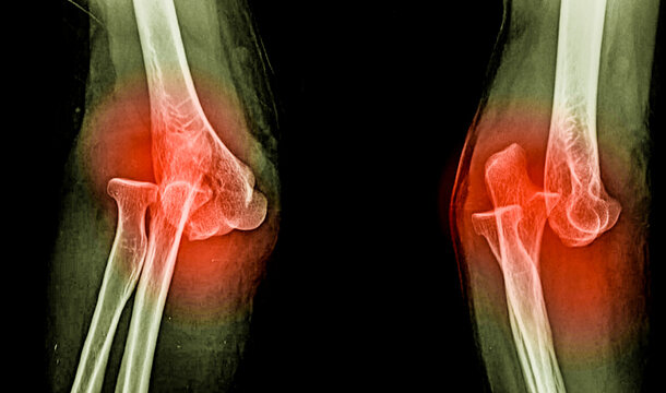 An x-ray image of elbow dislocation 