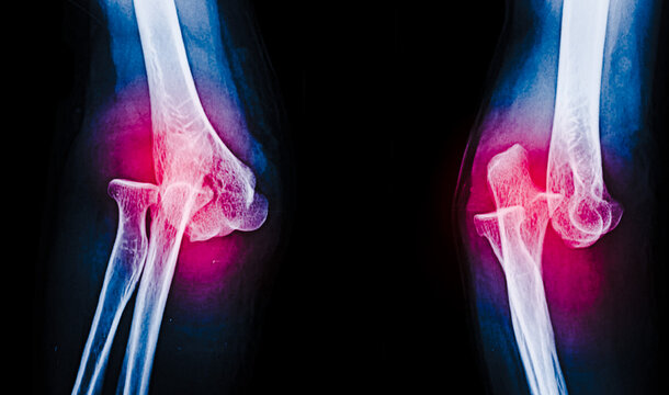 An x-ray image of elbow dislocation 