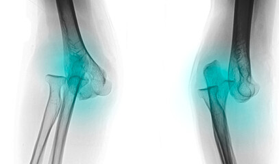 An x-ray image of elbow dislocation 