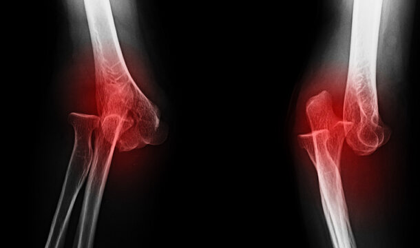 An x-ray image of elbow dislocation 