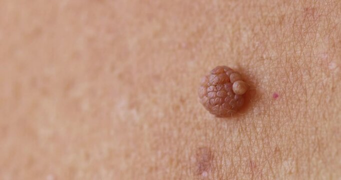 Mole big wart on skin woman. Concept dermatology body diseases papilloma or melanoma, Oncology malignant tumor.