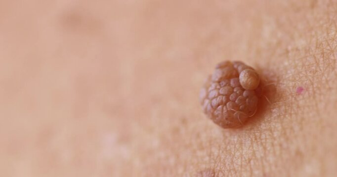 Mole big wart on skin woman. Concept dermatology body diseases papilloma or melanoma, Oncology malignant tumor.