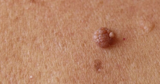 Red mole, growth, wart papilloma, nevus on armpit skin woman, banner medical dermatology.