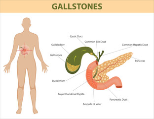 Anatomical diagram showing gallstones in the gallbladder with labelled bile ducts, pancreas, and digestive system organs. Medical illustration of gallstones in the body.

