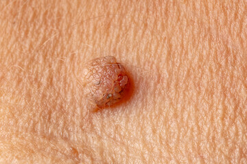 Mole big wart on skin woman. Concept dermatology body diseases papilloma or melanoma, Oncology...