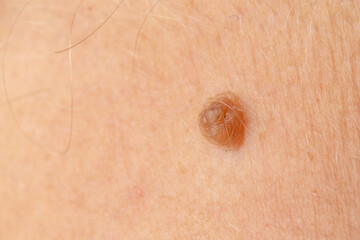 Close-up of caucasian adult skin mole on light surface