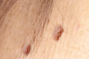 Close-up of skin with moles and hair on mature caucasian adult male
