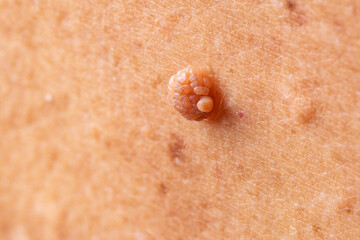 Oncology mole big wart on skin old woman. Concept dermatology body diseases malignant tumor