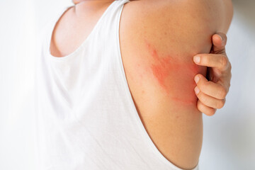 Close up of a person scratching a red, inflamed rash on their armpit and back area. Concept for skin irritation, allergy, dermatitis, or fungal infection. Healthcare and dermatology theme.