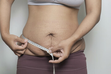 woman measure her postpartum belly with stretch marks, problem after giving birth. promoting body positivity and the reality of motherhood