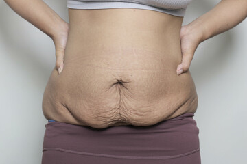 woman postpartum belly with stretch marks, problem after giving birth. promoting body positivity...