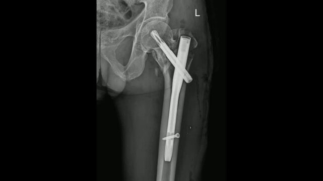 X-ray shows a left proximal femur with internal fixation