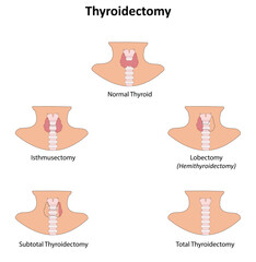 Thyroidectomy vector illustration