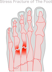 Stress fracture foot. X-ray, roentgen sample. Top foot x ray, big toe symptom structure. Orthopedic patients surgery anatomy.  Joint deformity feet bones. Illustration, medical vector