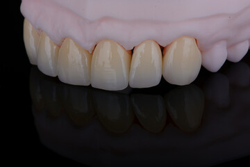 High-quality six dental crowns made of zirconium for fixation to the frontal teeth of upper jaw.
