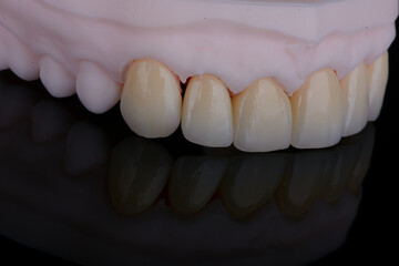 High-quality six dental crowns made of zirconium for fixation to the frontal teeth of upper jaw.