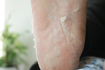 Dry skin treatment on cracked heel with focus on foot care