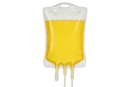 Yellow plasma iv drip bag hanging, medical fluid ready for patient treatment, transparent medical equipment background