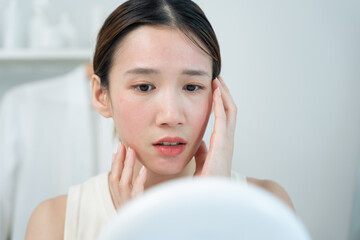 Woman worried about face Dermatology, rosacea dermatitis, allergic steroids, sensitive skin, red...