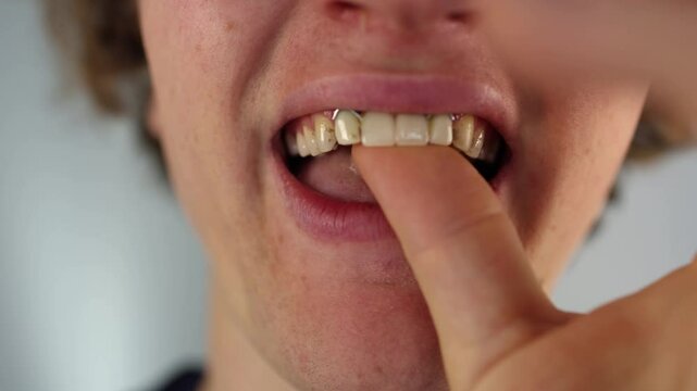Severe dental decay and missing teeth shown in extreme close-up highlight long-term damage likely caused by poor hygiene and excessive sugar consumption
