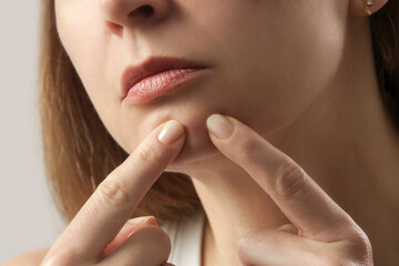 Young woman with a pimple on a chin. Inflamed acne and post-acne marks, redness. Hormonal adult...