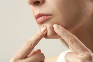 Young woman with a pimple on a chin. Inflamed acne and post-acne marks, redness. Hormonal adult...