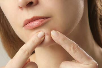 Young woman with a pimple on a chin. Inflamed acne and post-acne marks, redness. Hormonal adult...