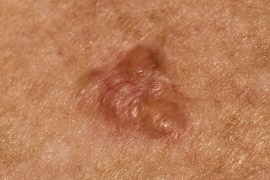 Basal cell carcinoma on the chest of a seventy year old Caucasian woman who has lived all her life in Africa