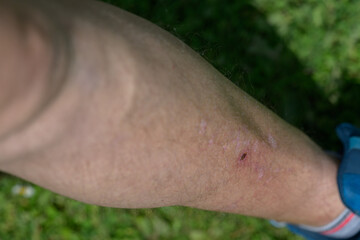 Minor skin abrasion on the leg.
