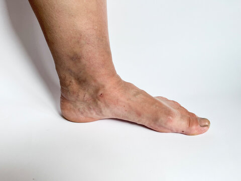First signs of vein disorder as subtle swelling and visible surface veins, indicating early-stage venous insufficiency in adult lower limb. signs venous reflux or chronic venous insufficiency.