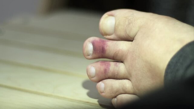 Toes with hematomas after injury. Red spots from internal bleeding under the skin. Leg injury.