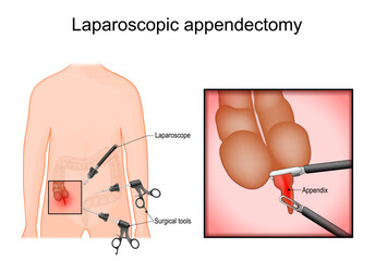 Laparoscopic surgery. Appendectomy