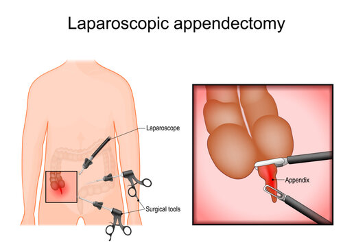 Laparoscopic surgery. Appendectomy