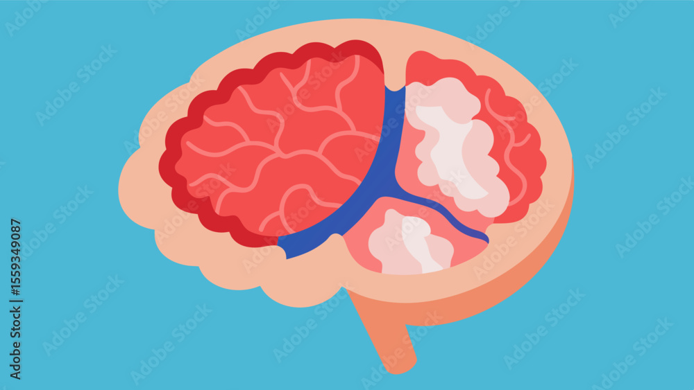 Poster crosssection of a brain affected by stroke displaying a blocked or ruptured vessel and its resulting