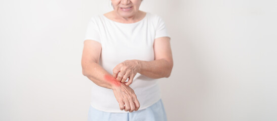 Elderly woman itching arm and body scratching for Skin Allergy from insect bite and food...