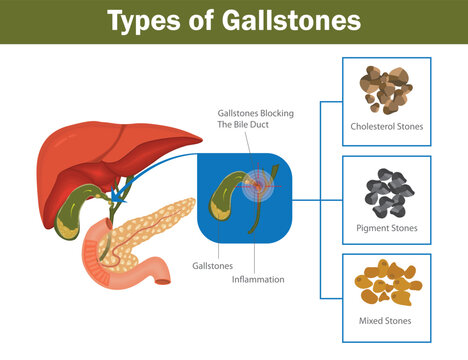 Types of gallstones medical diagram showing cholesterol stones, pigment stones, mixed stones, and gallstone blockage in bile duct. Medical diagram showing types of gallstones.
