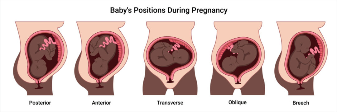 Different baby positions in the uterus during pregnancy. Dark-skinned woman. Anterior, Posterior, Cephalic, Breech, Transverse, Oblique positions. Pathology. Detailed medical vector illustration. 
