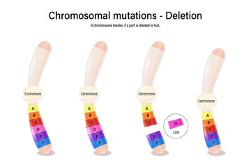 A chromosomal deletion. Chromosomal mutations. Various genetic disorders. Alteration of chromosome structure. Vector used for scientific and medical education. 
